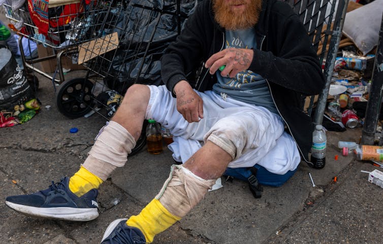 Lower body of man sitting on ground surrounded by garbage with wound dressings on both legs