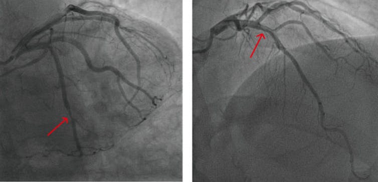 Side-by-side comparisons of two angiographies of heart arteries, the left with coronary artery disease and the right with coronary microvascular disease