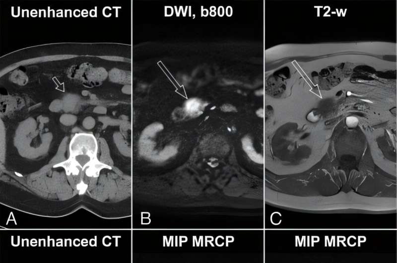 A promising future in pancreatic incidentaloma detection