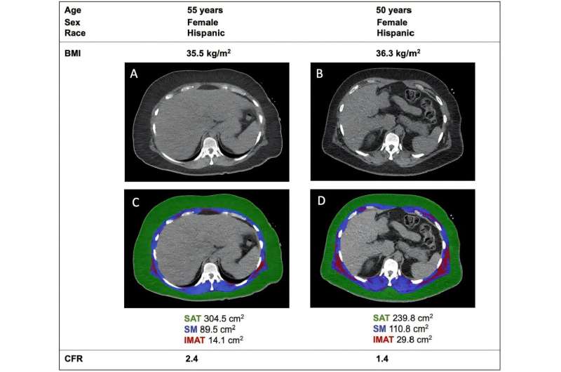 Fatty muscles raise the risk of serious heart disease regardless of overall body weight