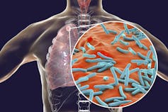 Computer illustration of the microbes that cause TB.