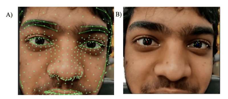 Mesh-grid-on-the-subject's-face-through-AI-based-algorithm. Credit: Cureus (2025). DOI: 10.7759/cureus.84036 'Eye' on health: AI detects dizziness and balance disorders remotely