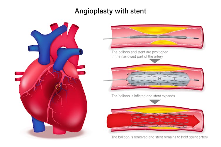 Illustration showing treatment of clogged arteries with three steps of angioplasty procedure