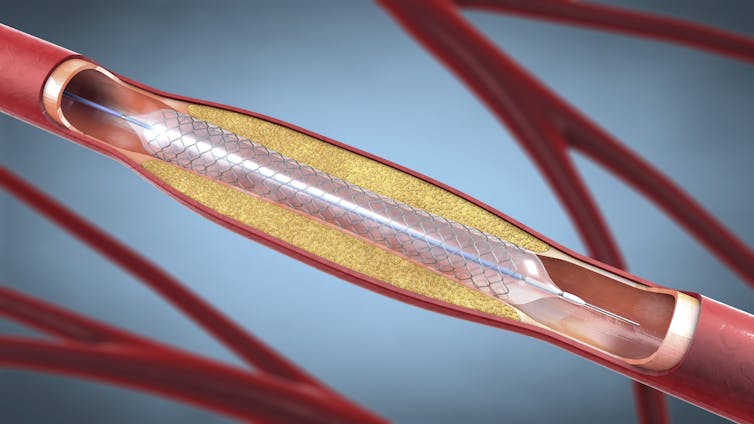Illustration of a metal stent for implantation into blood vessels.