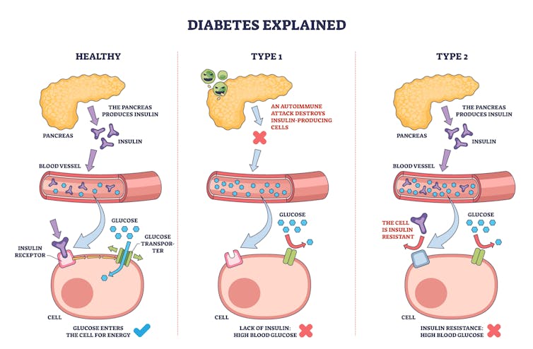 Infographic explaining glucose uptake and response to insulin in type 1 and type 2 diabetes.