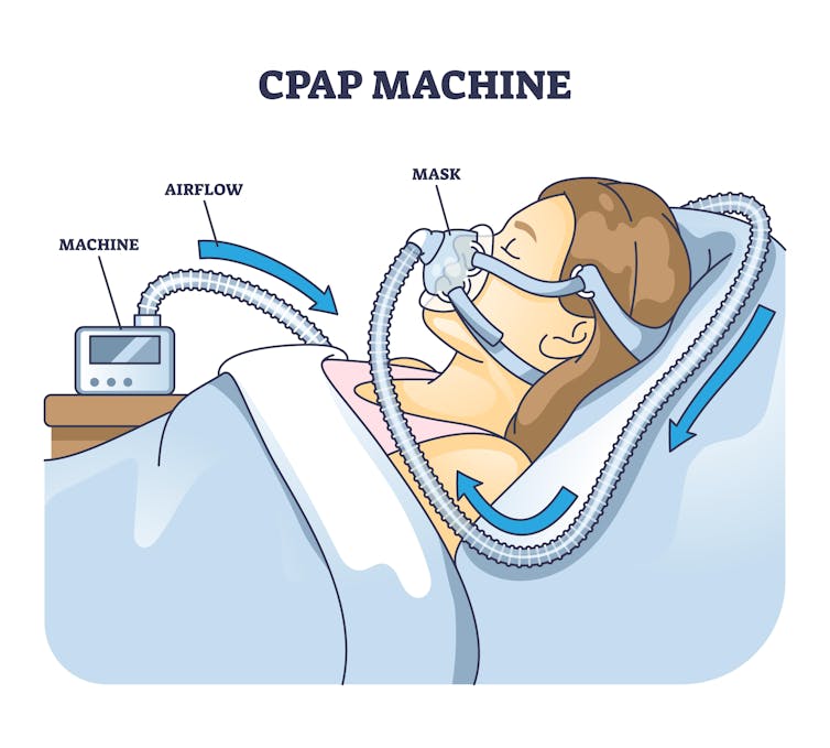 CPAP machine diagram with arrows pointing to air flow on a person wearing a mask in a bed.